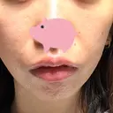 ボトックス（あご） / ヒアルロン酸注入（唇） / ボトックス（眉間） LA CLEF CLINIC（ラクレクリニック） DAY 1 サムネイル用