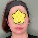 あごプロテーゼ くさのたろうクリニック DAY 189 サムネイル用