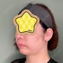あごプロテーゼ くさのたろうクリニック DAY 189 サムネイル用