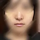 鼻尖形成（切開） / 軟骨移植 / 眉間プロテーゼ / 小鼻縮小（非切開） / 鼻柱下降・鼻唇角形成（猫手術） グローバルビューティークリニック 東京院 DAY 7 サムネイル用