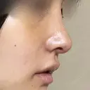 鼻尖形成（切開） / 軟骨移植 / 眉間プロテーゼ / 小鼻縮小（非切開） / 鼻柱下降・鼻唇角形成（猫手術） グローバルビューティークリニック 東京院 DAY 7 サムネイル用