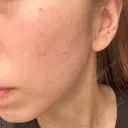 ピコフラクショナルレーザー（毛穴・ニキビ跡） CLINICA BellaForma AFTER サムネイル用