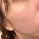 ピコフラクショナルレーザー（毛穴・ニキビ跡） CLINICA BellaForma DAY 25 サムネイル用