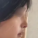 鼻尖形成（切開） / 軟骨移植 / 眉間プロテーゼ / 小鼻縮小（非切開） / 鼻柱下降・鼻唇角形成（猫手術） グローバルビューティークリニック 東京院 DAY 8 サムネイル用