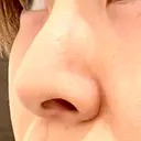 ヒアルロン酸注入（鼻） BIANCA銀座 DAY 12 サムネイル用