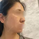 脂肪溶解注射（顔） TCB東京中央美容外科 横浜院 DAY 16 サムネイル用