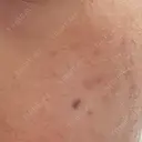 ピコスポット LOUIS CLINIC 二子玉川院【ルイクリニック】 DAY 8 サムネイル用