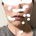 脂肪吸引（顔） / ジョールファット除去 / 脂肪注入（輪郭） WOM CLINIC GINZA （ワム クリニック ギンザ） DAY 32 サムネイル用