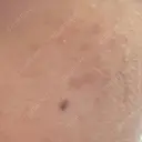 ピコスポット LOUIS CLINIC 二子玉川院【ルイクリニック】 DAY 9 サムネイル用