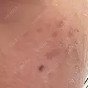 ピコスポット LOUIS CLINIC 二子玉川院【ルイクリニック】 DAY 11 サムネイル用