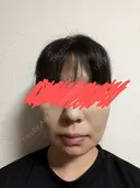 メーラーファット除去 WOM CLINIC GINZA （ワム クリニック ギンザ） DAY 1 サムネイル用