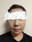 メーラーファット除去 WOM CLINIC GINZA （ワム クリニック ギンザ） DAY 2 サムネイル用