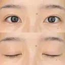 二重埋没 / 自然癒着法 シンデレラ＆ダヴィンチクリニック DAY 771 サムネイル用