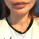 ボトックス（あご） / ヒアルロン酸注入（あご） KAGA CLINIC DAY 5 サムネイル用