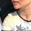 ボトックス（あご） / ヒアルロン酸注入（あご） KAGA CLINIC DAY 5 サムネイル用