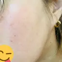 毛穴洗浄（ハイドラフェイシャルなど） / ピコフラクショナルレーザー（毛穴・ニキビ跡） CHARIS BEAUTY CLINIC AFTER サムネイル用