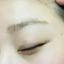 ほくろ・いぼ除去レーザー（肌） 心斎橋形成外科スキンケアクリニック AFTER サムネイル用