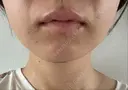 脂肪吸引（顔） / その他（輪郭） THE CLINIC（ザ・クリニック） 東京院 DAY 12 サムネイル用
