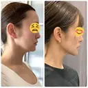 脂肪吸引（顔） / 輪郭修正 / ジョールファット除去 / 脂肪注入（輪郭） WOM CLINIC GINZA （ワム クリニック ギンザ） AFTER サムネイル用
