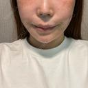 脂肪吸引（顔） / 切開リフト タシピウム整形外科 DAY 90 サムネイル用