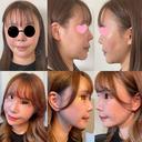 脂肪吸引（顔） / 切開リフト タシピウム整形外科 DAY 97 サムネイル用