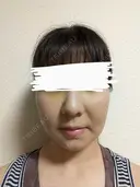 メーラーファット除去 WOM CLINIC GINZA （ワム クリニック ギンザ） DAY 5 サムネイル用