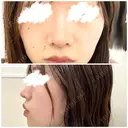鼻尖形成（切開） / 小鼻縮小（切開） / 軟骨移植 / 鼻尖縮小 高崎美容クリニック DAY 64 サムネイル用