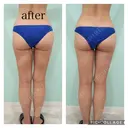 脂肪吸引（二の腕） / 脂肪吸引（肩） / 医療痩身（太もも） / 肌ヒアルロン酸注入（たるみ・シワ改善） / シワ取りボトックス WOM CLINIC GINZA （ワム クリニック ギンザ） DAY 33 サムネイル用