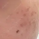 ピコスポット LOUIS CLINIC 二子玉川院【ルイクリニック】 DAY 17 サムネイル用