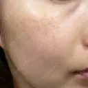 レーザートーニング（美白・肝斑） 渋谷美容外科クリニック 横浜院 DAY 0 サムネイル用