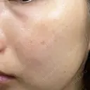 レーザートーニング（美白・肝斑） 渋谷美容外科クリニック 横浜院 DAY 0 サムネイル用