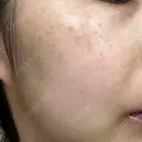 レーザートーニング（美白・肝斑） 渋谷美容外科クリニック 横浜院 DAY 10 サムネイル用