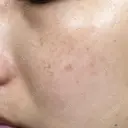 レーザートーニング（美白・肝斑） 渋谷美容外科クリニック 横浜院 DAY 10 サムネイル用