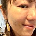 ボトックス（目尻） TCB東京中央美容外科 立川院 DAY 9 サムネイル用