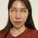 二重埋没 / 人中短縮 / 目尻切開 / 口角挙上 ヴェリテクリニック 名古屋院 DAY 8 サムネイル用