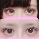 二重切開 / 目頭切開 / ヒアルロン酸注入（涙袋） FROM B整形外科 (旧バウム整形外科) DAY 78 サムネイル用