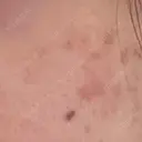 ピコスポット LOUIS CLINIC 二子玉川院【ルイクリニック】 DAY 20 サムネイル用