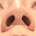 ヒアルロン酸注入（鼻） BIANCA銀座 AFTER サムネイル用
