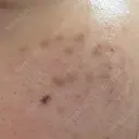 ピコスポット LOUIS CLINIC 二子玉川院【ルイクリニック】 DAY 23 サムネイル用