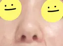 小鼻縮小（切開） / 鼻翼挙上 / 鼻孔縁挙上 / 鼻柱下降・鼻唇角形成（猫手術） Otus Clinic 【オータスクリニック】 DAY 12 サムネイル用