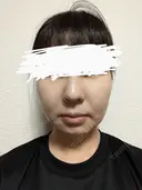 メーラーファット除去 WOM CLINIC GINZA （ワム クリニック ギンザ） DAY 11 サムネイル用