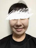 メーラーファット除去 WOM CLINIC GINZA （ワム クリニック ギンザ） DAY 11 サムネイル用