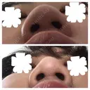鼻尖形成（切開） / 小鼻縮小（切開） / その他（鼻） / 軟骨移植 JUN CLINIC DAY 35 サムネイル用