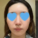 ピーリング（ニキビ・毛穴） / ピコフラクショナルレーザー（毛穴・ニキビ跡） CLINICA BellaForma DAY 4 サムネイル用