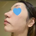 ピーリング（ニキビ・毛穴） / ピコフラクショナルレーザー（毛穴・ニキビ跡） CLINICA BellaForma DAY 4 サムネイル用