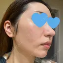 ピーリング（ニキビ・毛穴） / ピコフラクショナルレーザー（毛穴・ニキビ跡） CLINICA BellaForma DAY 4 サムネイル用