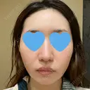 ピーリング（ニキビ・毛穴） / ピコフラクショナルレーザー（毛穴・ニキビ跡） CLINICA BellaForma DAY 5 サムネイル用