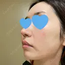 ピーリング（ニキビ・毛穴） / ピコフラクショナルレーザー（毛穴・ニキビ跡） CLINICA BellaForma DAY 5 サムネイル用