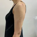 糸リフト / 脂肪吸引（顔） / 脂肪吸引（二の腕） / 脂肪吸引（肩） eクリニック 富山院 DAY 3 サムネイル用
