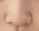 隆鼻術 / 小鼻縮小（切開） あいちビューティークリニック栄本院 DAY 17 サムネイル用